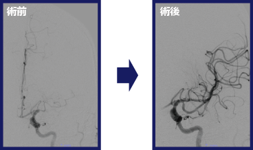 脳血管内治療症例